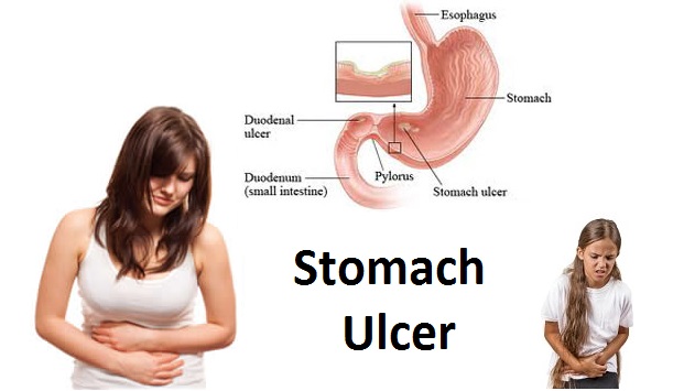 Stomach Ulcer Treatment in Mumbai